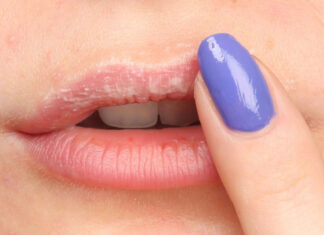 Dry lips - 8 tips for prevention & treatment (Guide)
